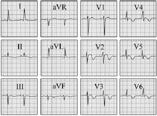 ECG answer 3