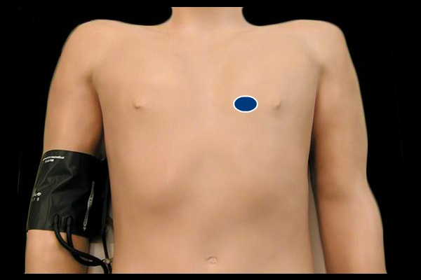 Precordial Impulse - normal location and size
