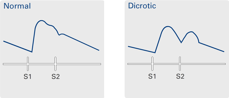 Dicrotic