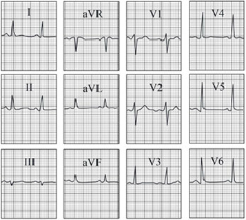 ECG answer 3