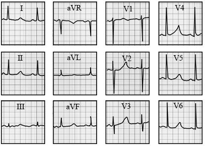 ECG answer 3