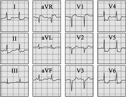 ECG answer 3