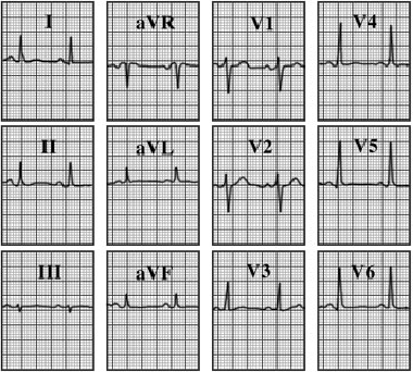 ECG answer 3