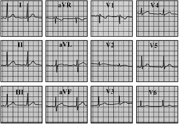 ECG answer 3