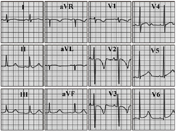 ECG answer 3