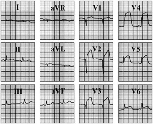 ECG answer 3