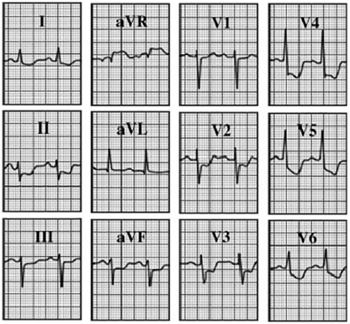 ECG answer 3