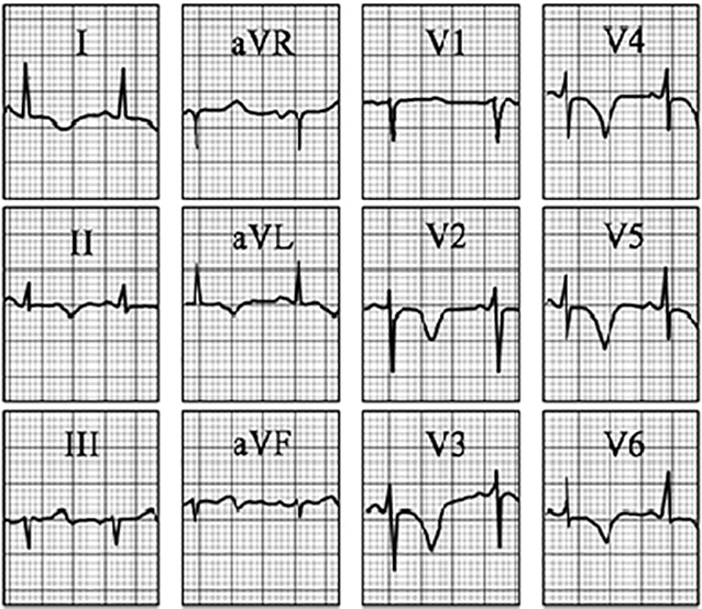 ECG answer 3