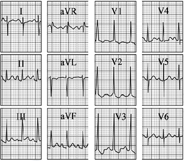 ECG answer 3