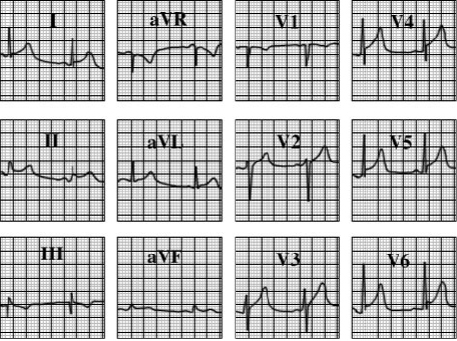 ecg