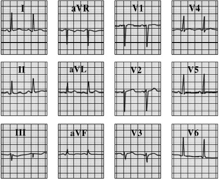 ECG answer 3