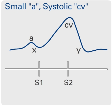 Systolic 'cv'