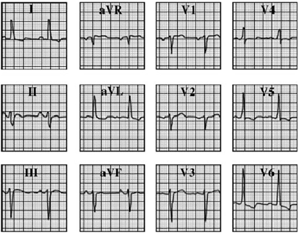 ECG answer 3