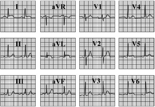 ECG answer 3