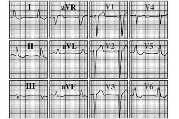 ecg