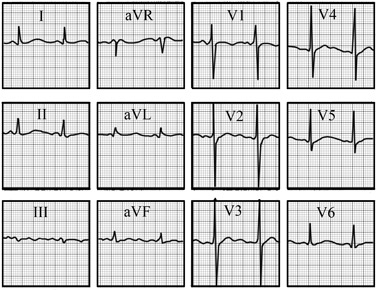 ECG answer 3