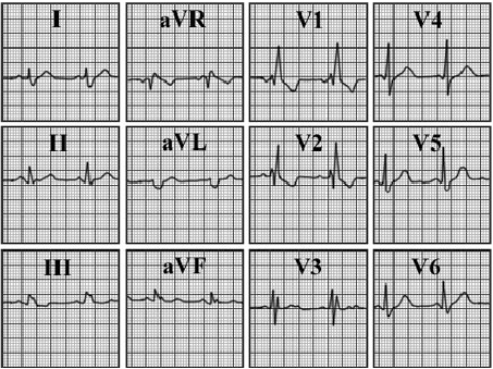 ecg