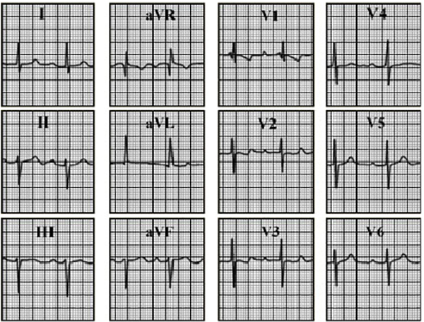 ECG answer 3